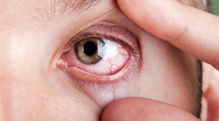 ojos llorosos de bloqueador