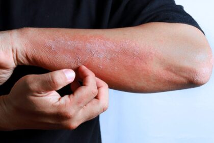 codo con problema de eczema