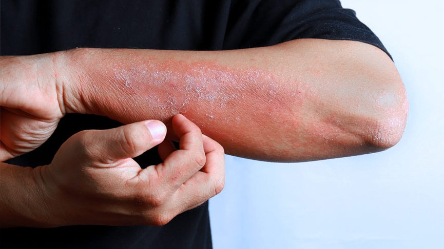 codo con problema de eczema